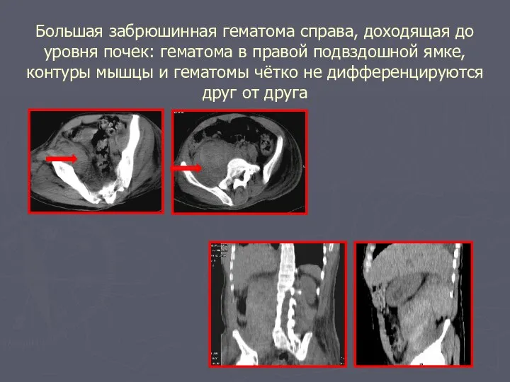 Большая забрюшинная гематома справа, доходящая до уровня почек: гематома в правой подвздошной ямке,