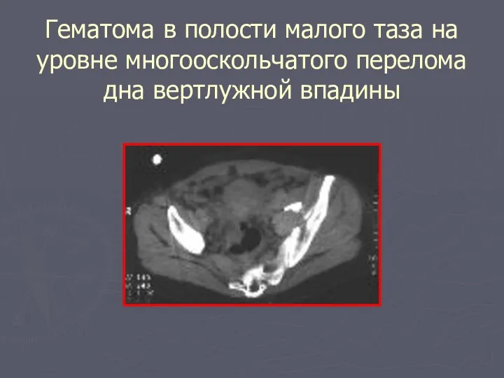 Гематома в полости малого таза на уровне многооскольчатого перелома дна вертлужной впадины