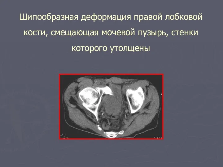 Шипообразная деформация правой лобковой кости, смещающая мочевой пузырь, стенки которого утолщены
