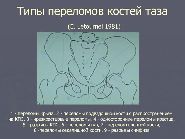 Типы переломов костей таза (E. Letournel 1981) 1 - переломы крыла, 2 -