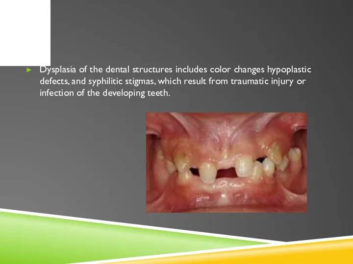 Dysplasia of the dental structures includes color changes hypoplastic defects,