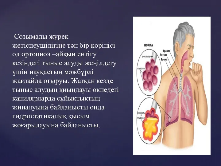 Созымалы жүрек жетіспеушілігіне тән бір көрінісі ол ортопноэ –айқын ентігу