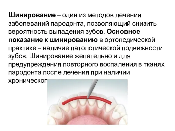 Шинирование – один из методов лечения заболеваний пародонта, позволяющий снизить вероятность выпадения зубов.
