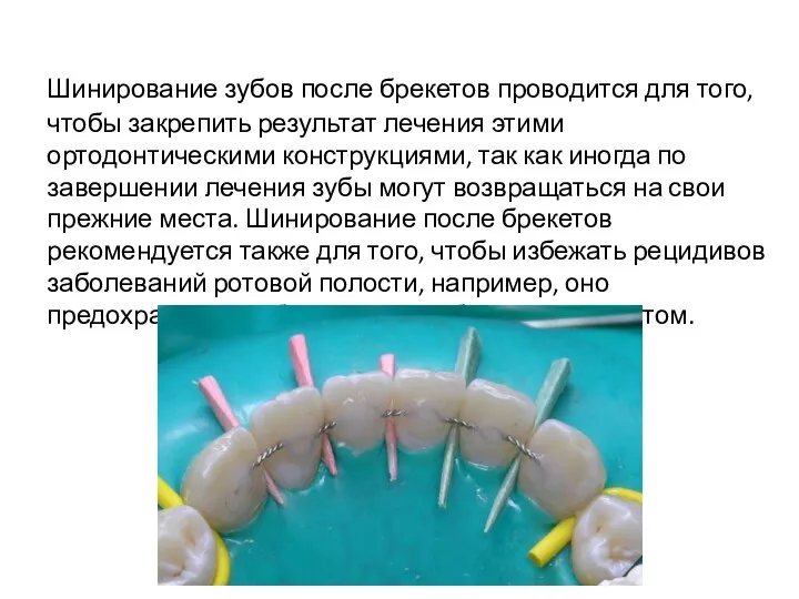 Шинирование зубов после брекетов проводится для того, чтобы закрепить результат лечения этими ортодонтическими