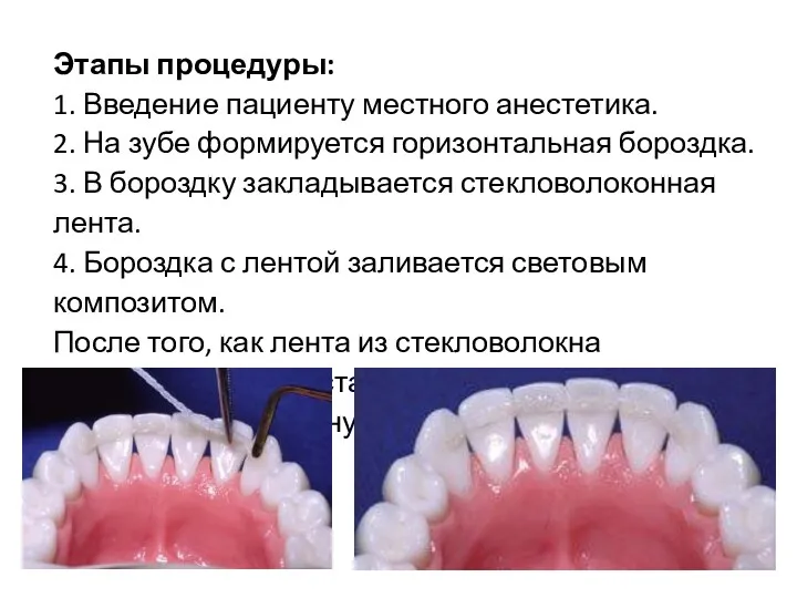 Этапы процедуры: 1. Введение пациенту местного анестетика. 2. На зубе формируется горизонтальная бороздка.
