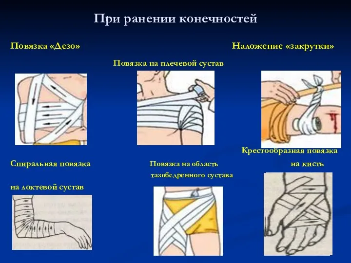 При ранении конечностей Повязка «Дезо» Наложение «закрутки» Повязка на плечевой