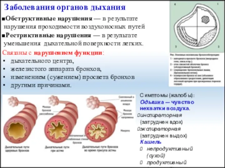 Заболевания органов дыхания Обструктивные нарушения — в результате нарушения проходимости