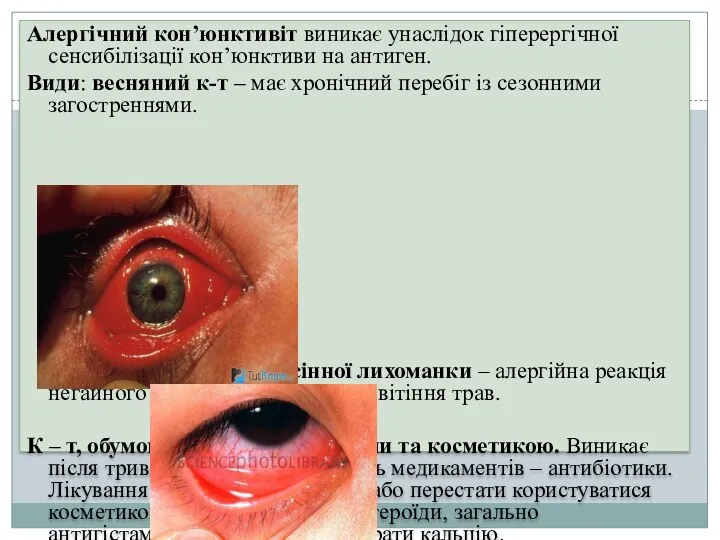 Алергічний кон’юнктивіт виникає унаслідок гіперергічної сенсибілізації кон’юнктиви на антиген. Види: