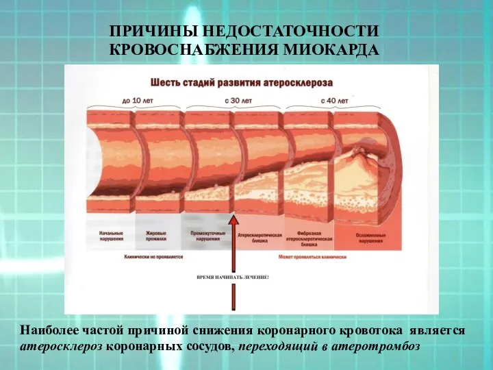 ПРИЧИНЫ НЕДОСТАТОЧНОСТИ КРОВОСНАБЖЕНИЯ МИОКАРДА Наиболее частой причиной снижения коронарного кровотока является атеросклероз коронарных