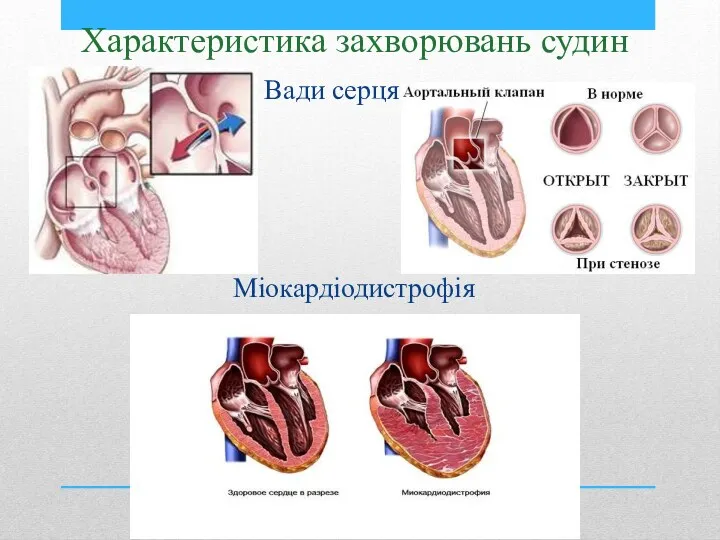 Вади серця Характеристика захворювань судин Міокардіодистрофія