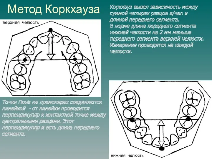Метод Коркхауза Коркхауз вывел зависимость между суммой четырех резцов в/чел и длиной переднего