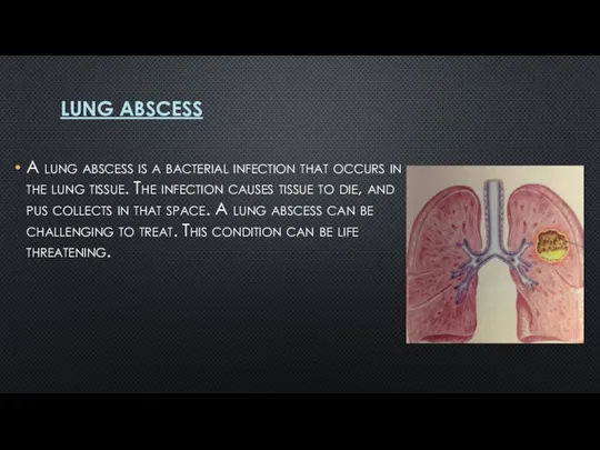 LUNG ABSCESS A lung abscess is a bacterial infection that occurs in the