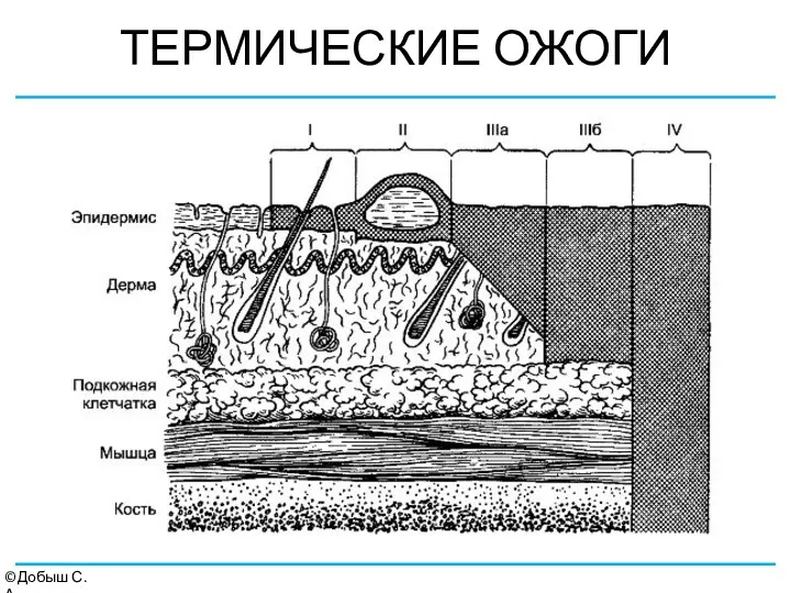 ТЕРМИЧЕСКИЕ ОЖОГИ ©Добыш С.А.