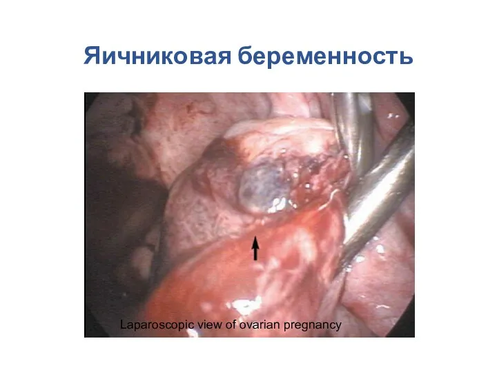 Яичниковая беременность Laparoscopic view of ovarian pregnancy