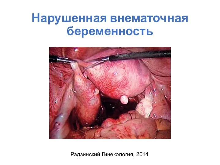 Нарушенная внематочная беременность Радзинский Гинекология, 2014