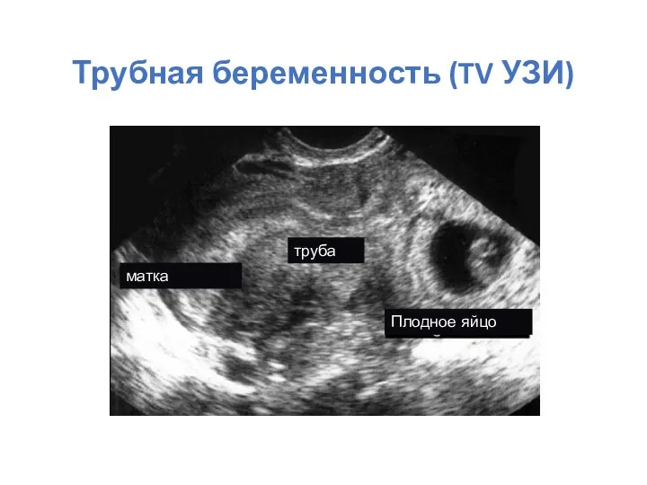 Трубная беременность (TV УЗИ) матка труба Плодное яйцо