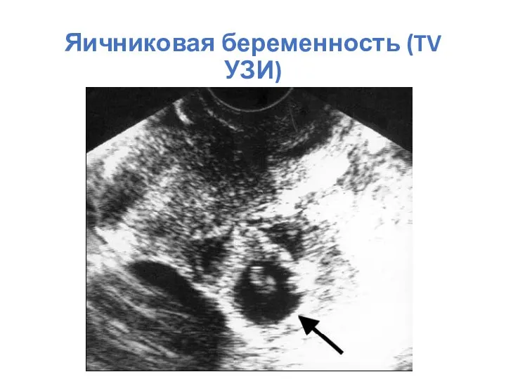 Яичниковая беременность (TV УЗИ)