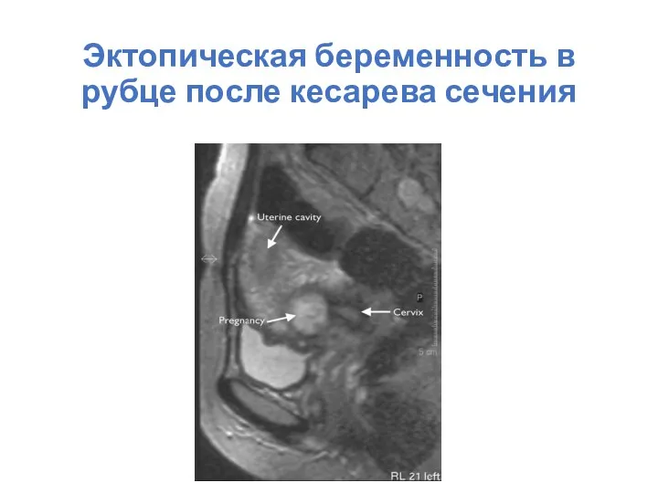 Эктопическая беременность в рубце после кесарева сечения