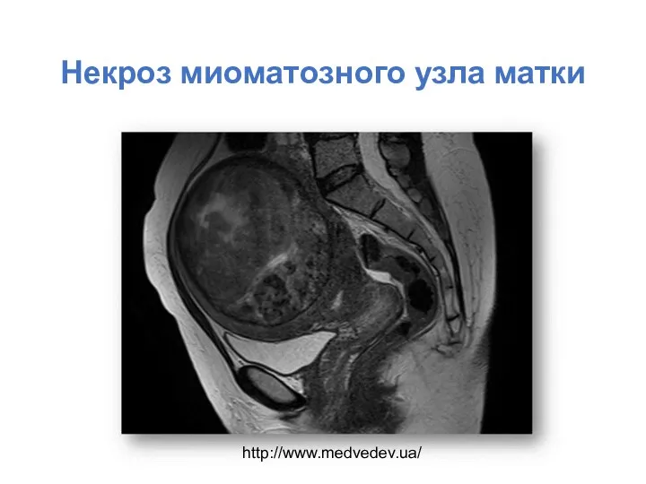 Некроз миоматозного узла матки http://www.medvedev.ua/