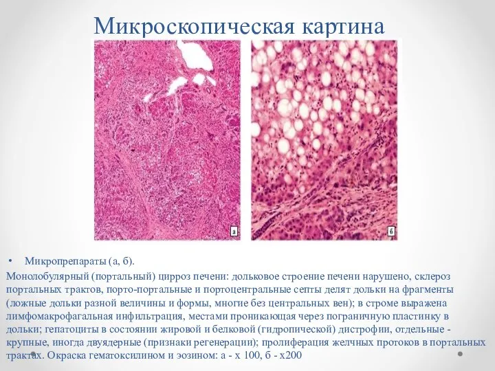 Микроскопическая картина Микропрепараты (а, б). Монолобулярный (портальный) цирроз печени: дольковое