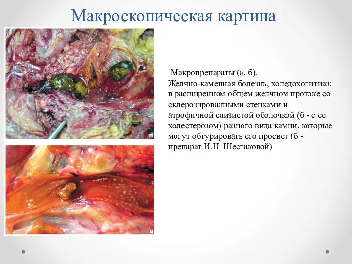 Макроскопическая картина Макропрепараты (а, б). Желчно-каменная болезнь, холедохолитиаз: в расширенном