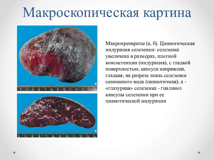 Макроскопическая картина Макропрепараты (а, б). Цианотическая индурация селезенки: селезенка увеличена