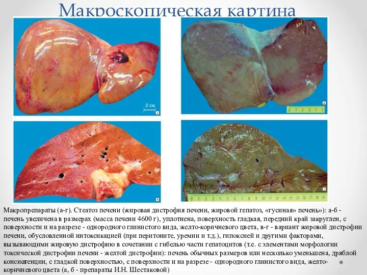 Макроскопическая картина Макропрепараты (а-г). Стеатоз печени (жировая дистрофия печени, жировой