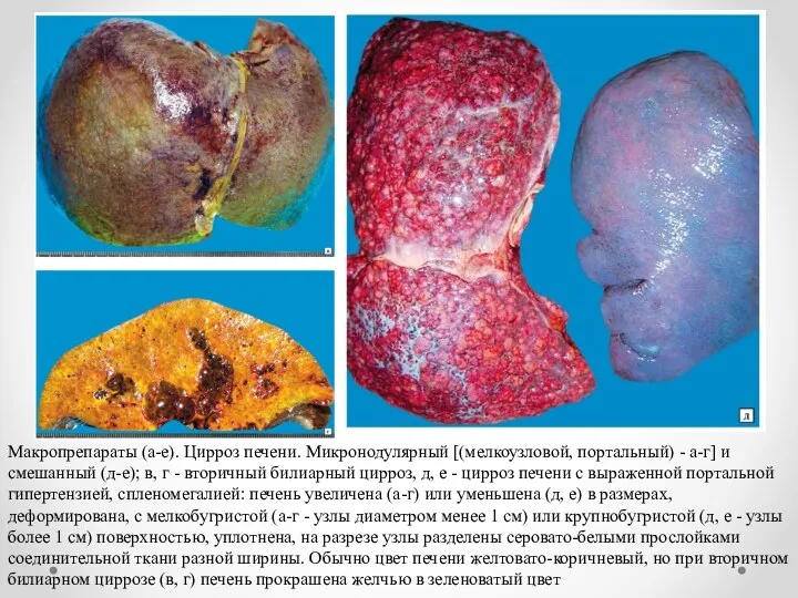 Макропрепараты (а-е). Цирроз печени. Микронодулярный [(мелкоузловой, портальный) - а-г] и