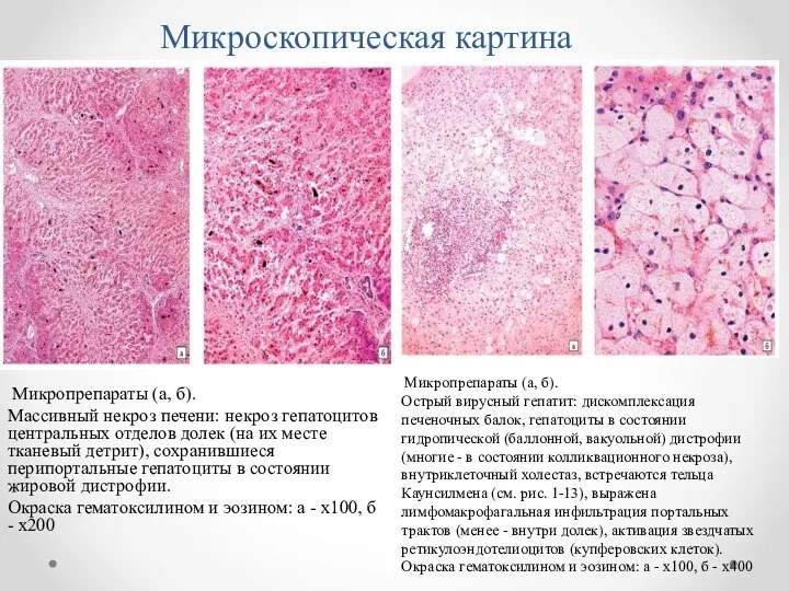 Микроскопическая картина Микропрепараты (а, б). Массивный некроз печени: некроз гепатоцитов