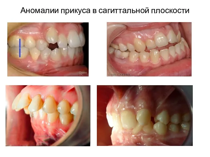 Аномалии прикуса в сагиттальной плоскости