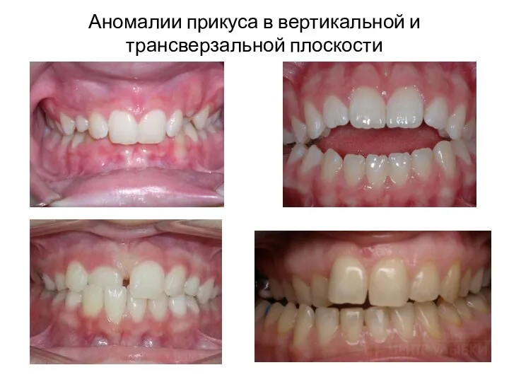 Аномалии прикуса в вертикальной и трансверзальной плоскости