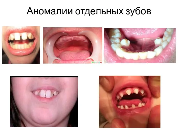 Аномалии отдельных зубов