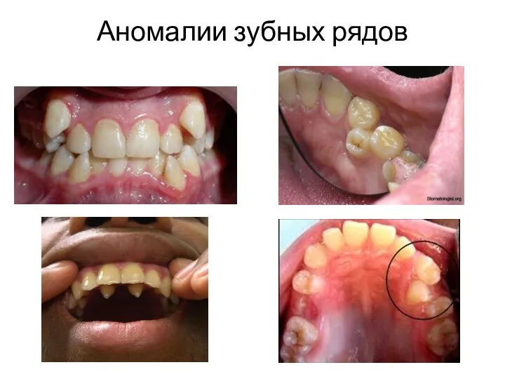 Аномалии зубных рядов