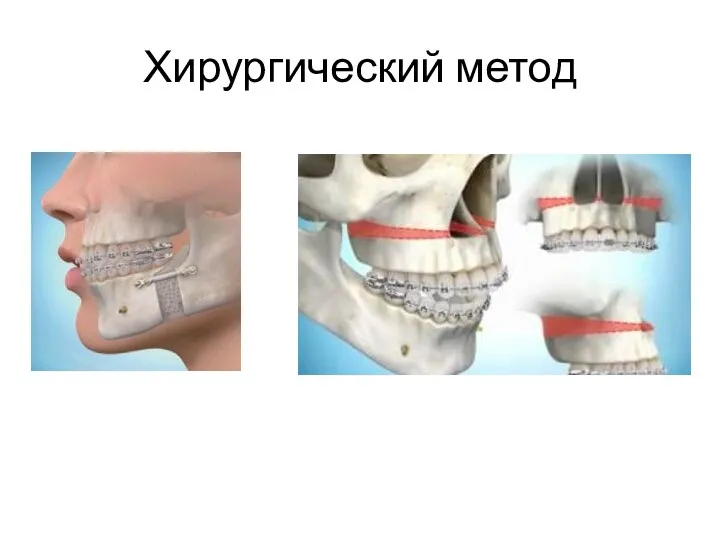 Хирургический метод