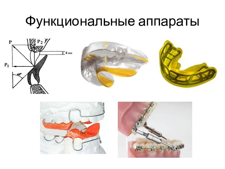 Функциональные аппараты