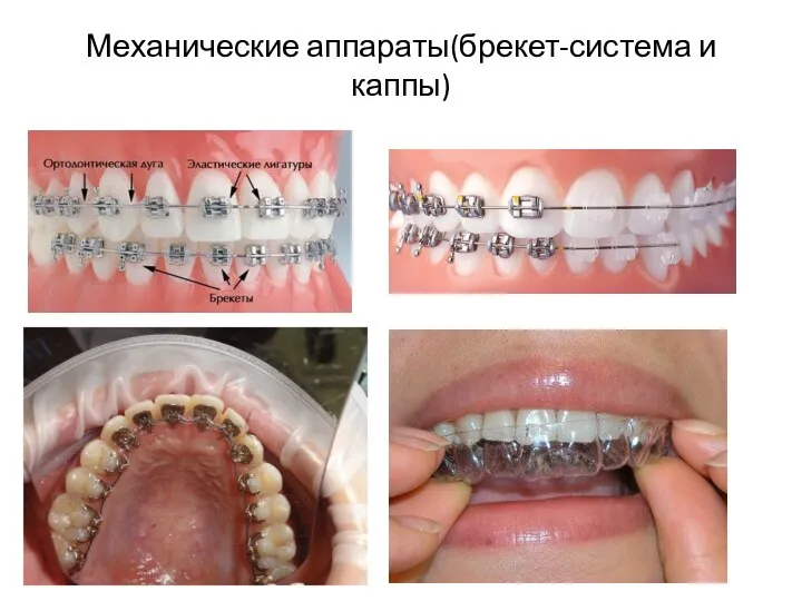 Механические аппараты(брекет-система и каппы)