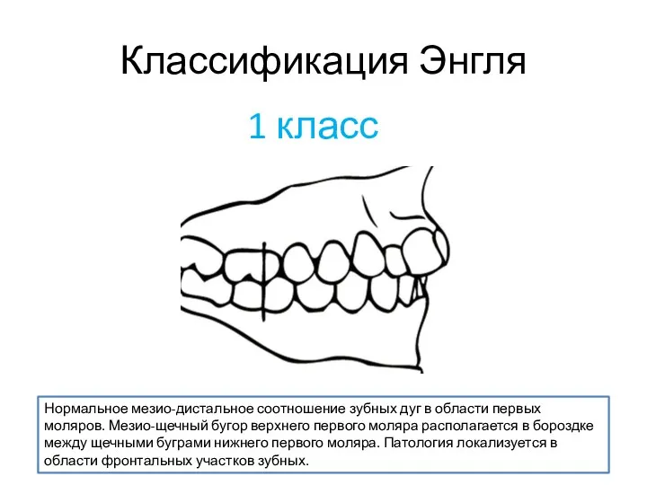 Классификация Энгля Нормальное мезио-дистальное соотношение зубных дуг в области первых моляров. Мезио-щечный бугор