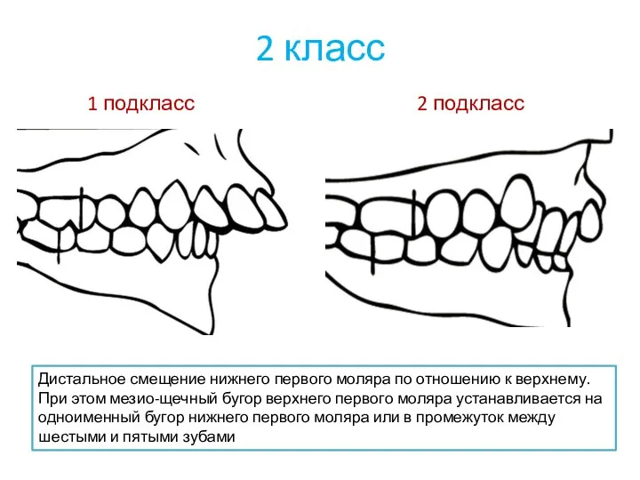 2 класс 1 подкласс 2 подкласс Дистальное смещение нижнего первого моляра по отношению