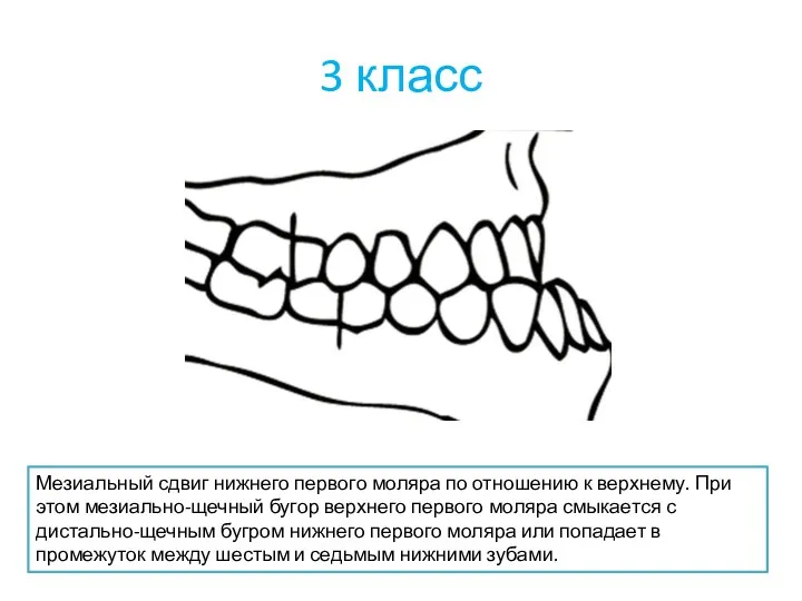 3 класс Мезиальный сдвиг нижнего первого моляра по отношению к верхнему. При этом