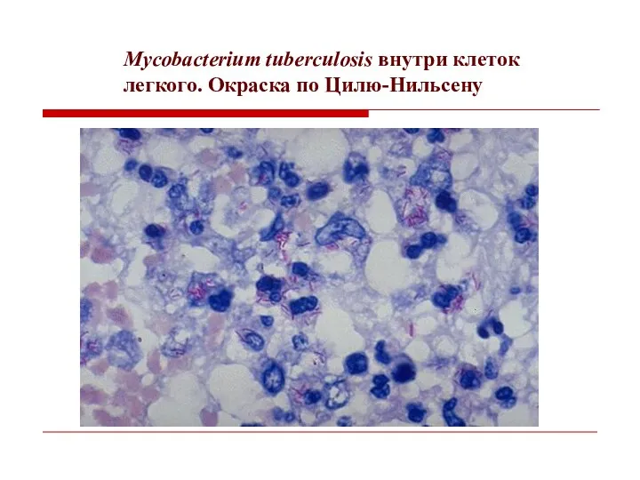 Mycobacterium tuberculosis внутри клеток легкого. Окраска по Цилю-Нильсену