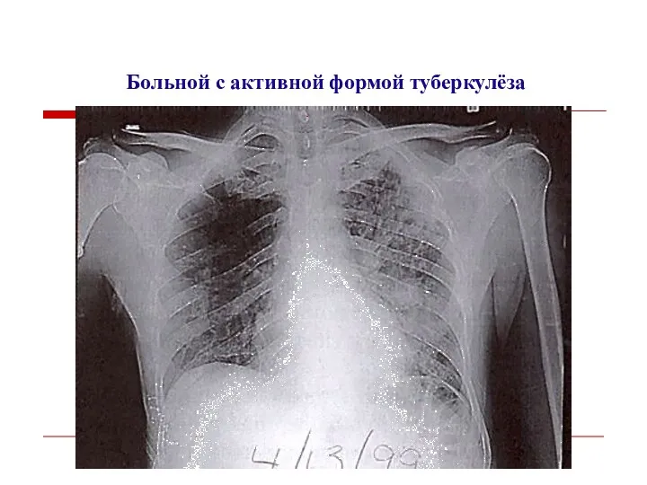 Больной с активной формой туберкулёза