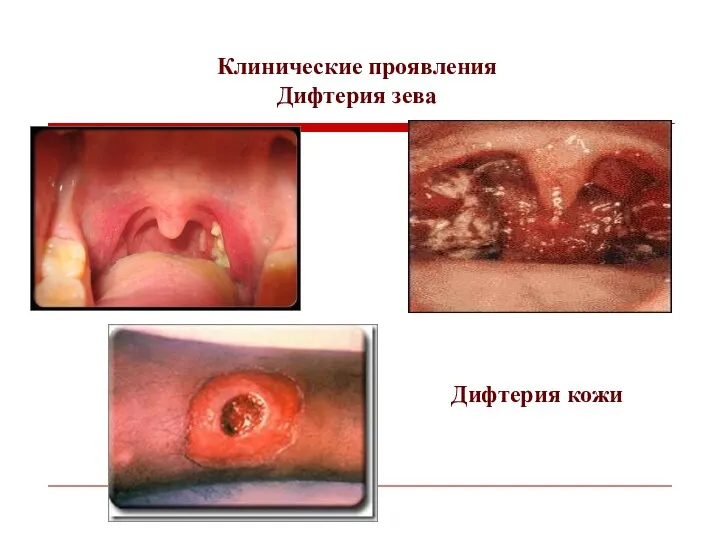 Клинические проявления Дифтерия зева Дифтерия кожи