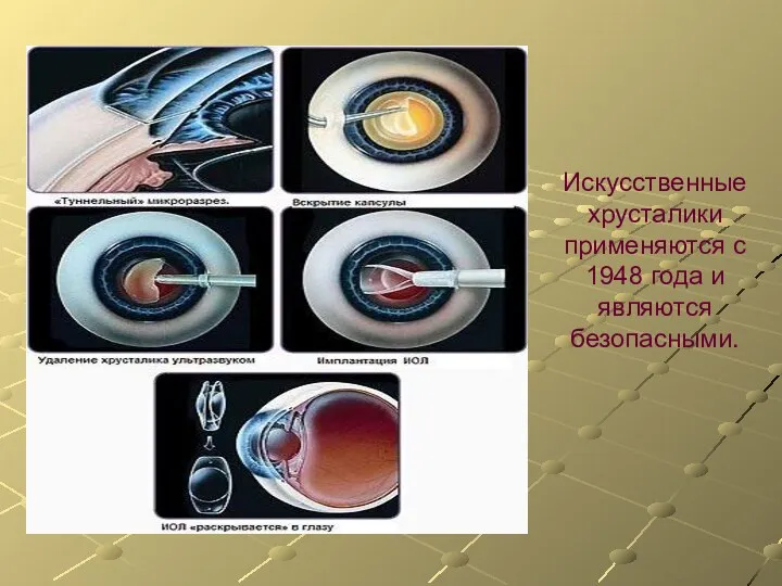 Искусственные хрусталики применяются с 1948 года и являются безопасными.
