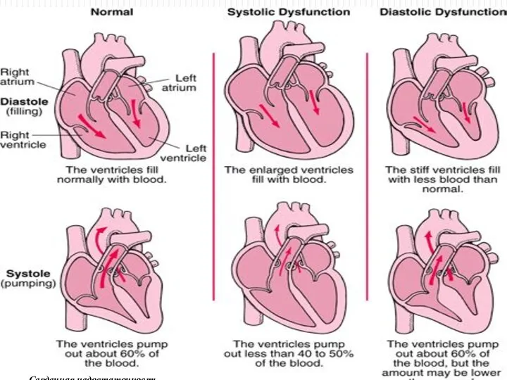 Сердечная недостаточность