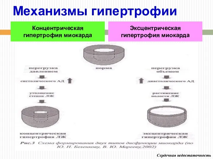 Механизмы гипертрофии Концентрическая гипертрофия миокарда Эксцентрическая гипертрофия миокарда Сердечная недостаточность