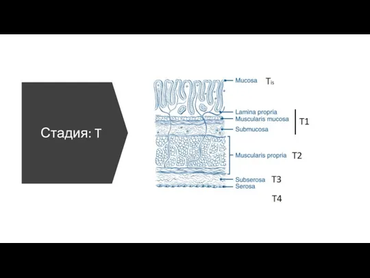 Стадия: T