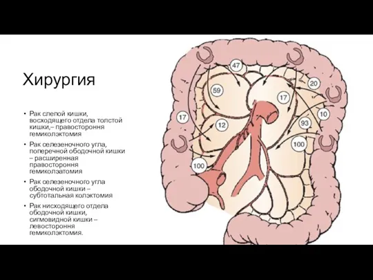 Хирургия Рак слепой кишки, восходящего отдела толстой кишки,– правостороння гемиколэктомия