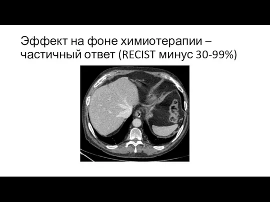 Эффект на фоне химиотерапии – частичный ответ (RECIST минус 30-99%)