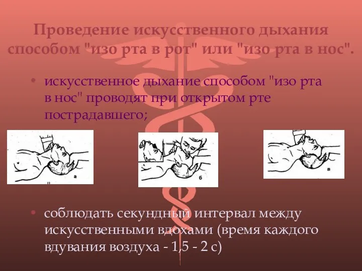 Проведение искусственного дыхания способом "изо рта в рот" или "изо рта в нос".