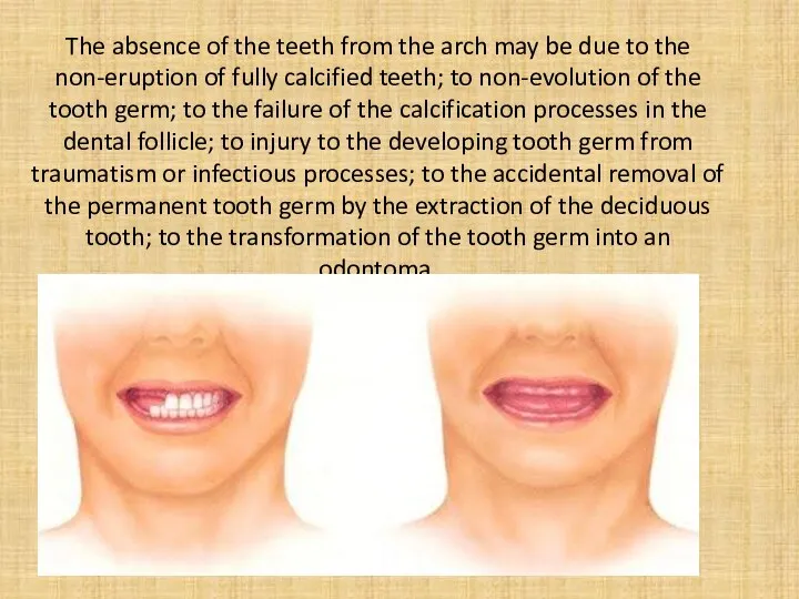 The absence of the teeth from the arch may be